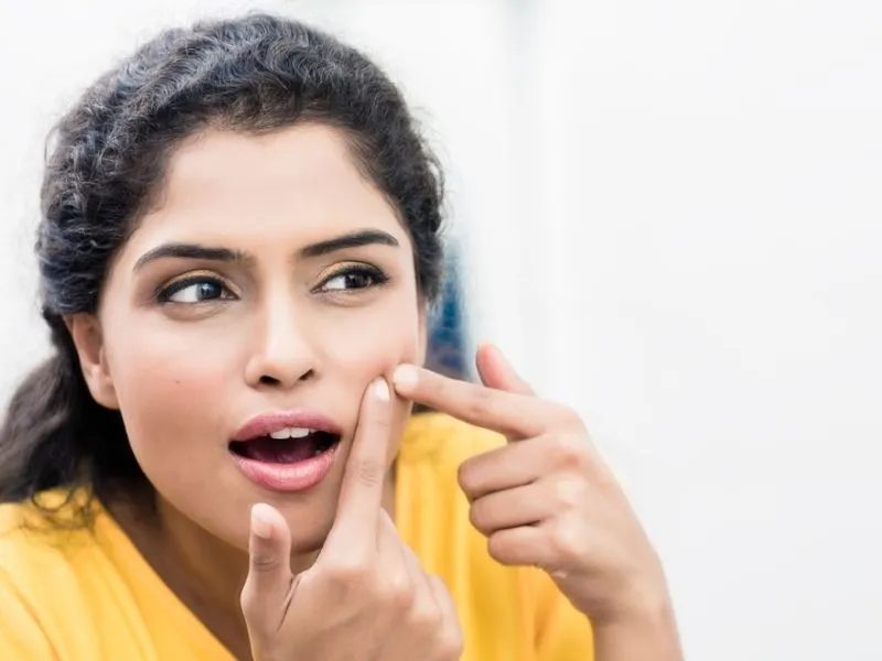 Acne scar treatment benefits