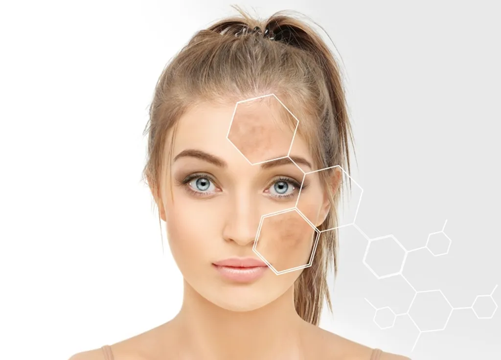 Acne scar treatment benefits