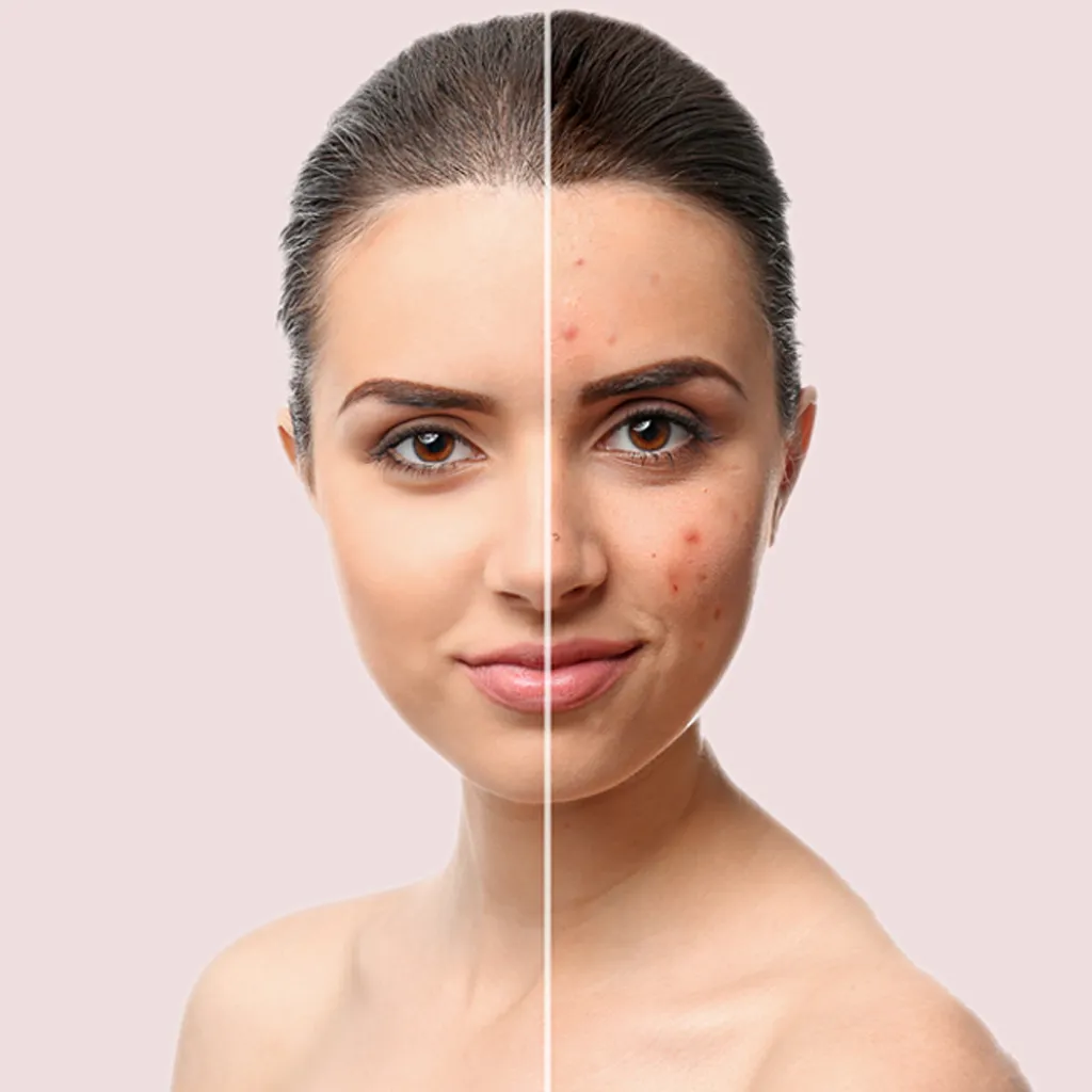 Dermal filler treatment
