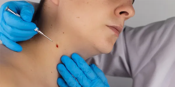 Cosmetic Excision