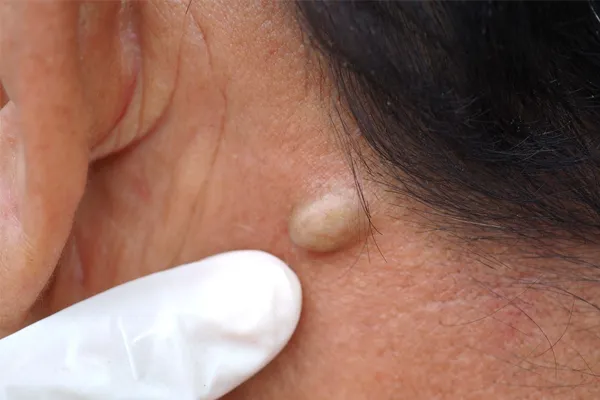 Cyst Excision Procedure
