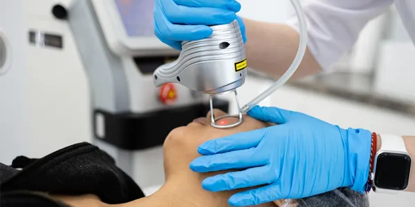 Laser Removal