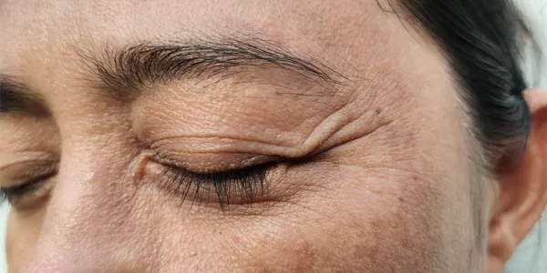 Lower Eyelid Surgery