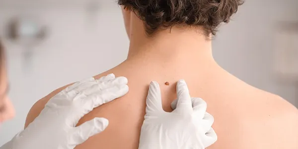 Minor Surgical Removal