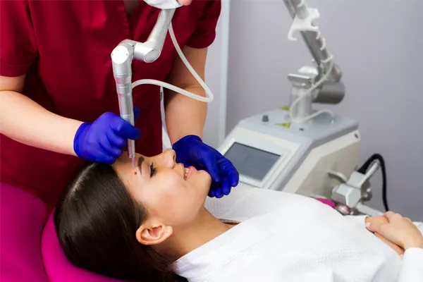 Mole Removal Procedure