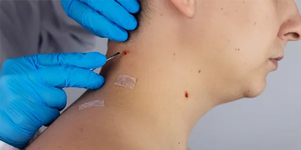 Surgical Excision