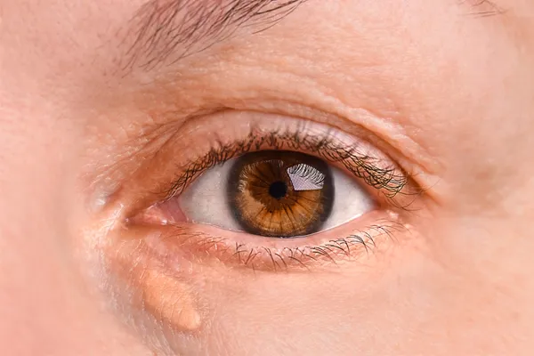 Xanthelasma Excision Procedure