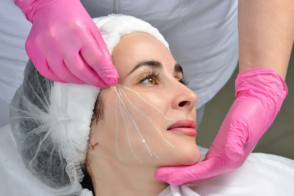 Dermal filler treatment